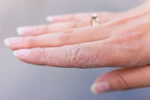 4 componentes essenciais para prevenir e tratar mãos ressecadas