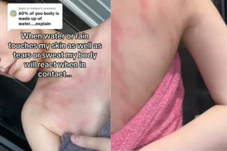 Chelsea, 23, sofre de alergia rara à água e revela dor intensa no banho agora