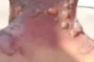 Mulher grávida acusada de cárcere e agressões queimando namorado com água fervente e deixando sequelas